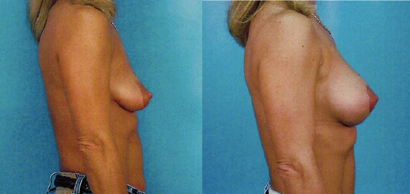 breast8