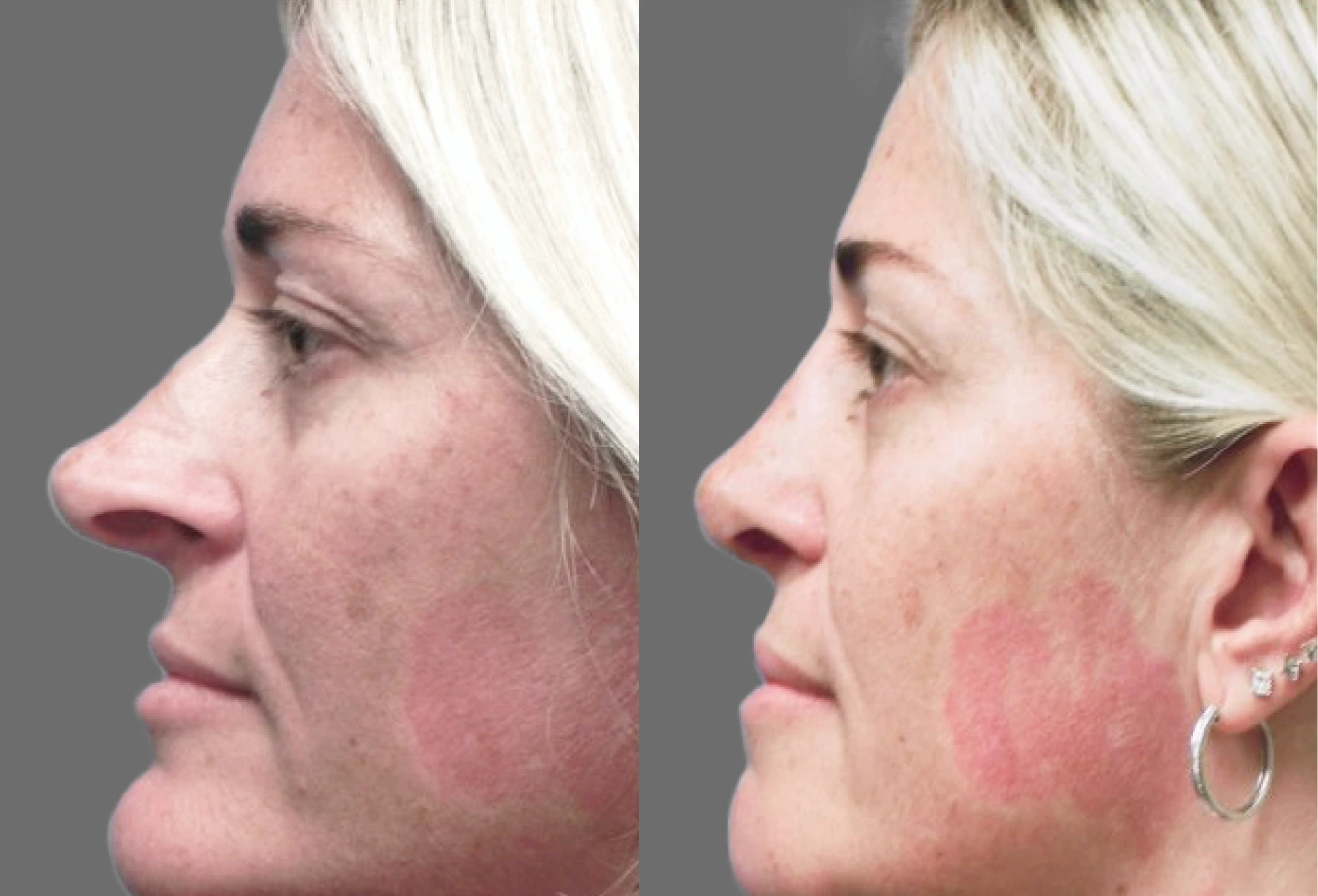 Rhinoplasty Before & after Banner