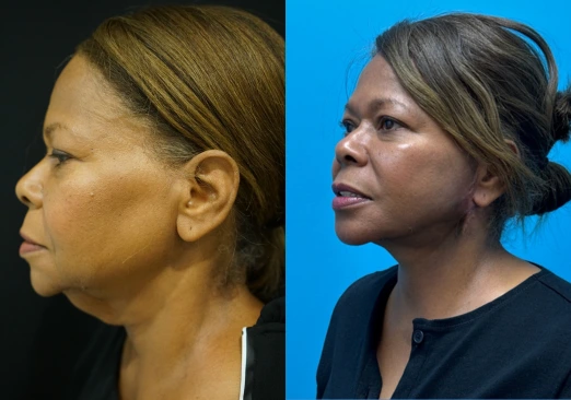 bafitis body and face (1)