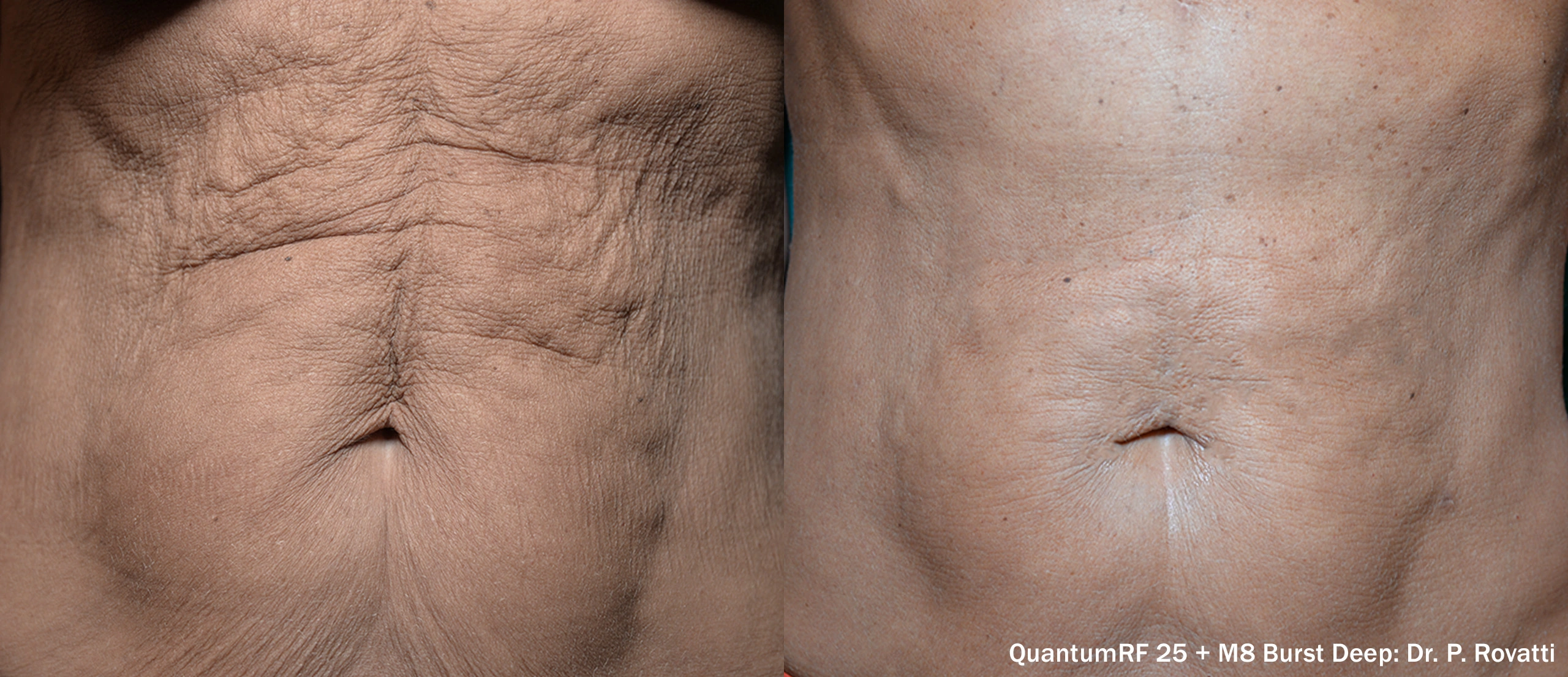 PR_QuantumRF_25_Abd_Female_Front_ShortTM (1)