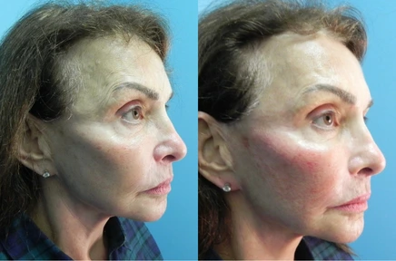 facelist-case-14-436 (1)