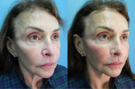 facelist-case-14-436 (4)