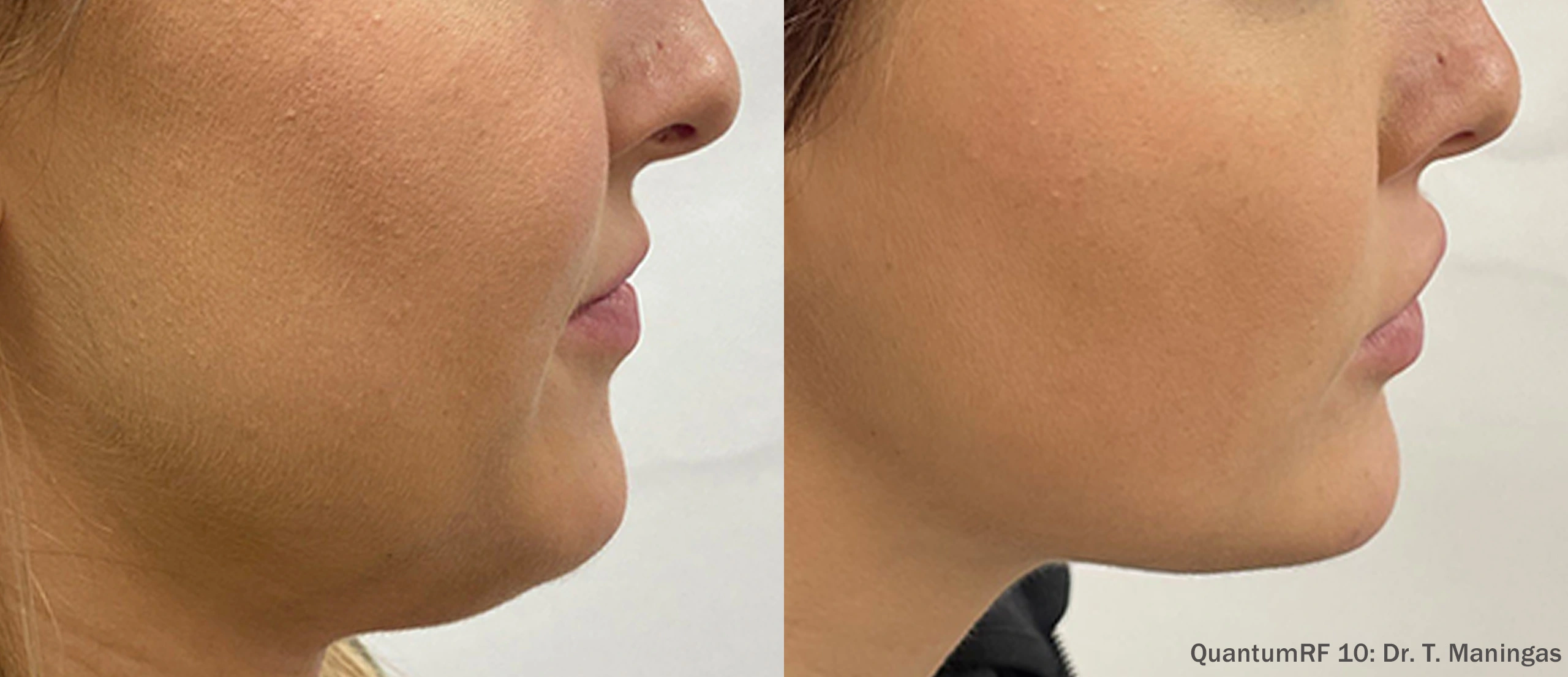 TM_QuantumRF_10_Face_RSide_ZI-TM