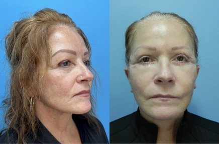 Before and After (1)