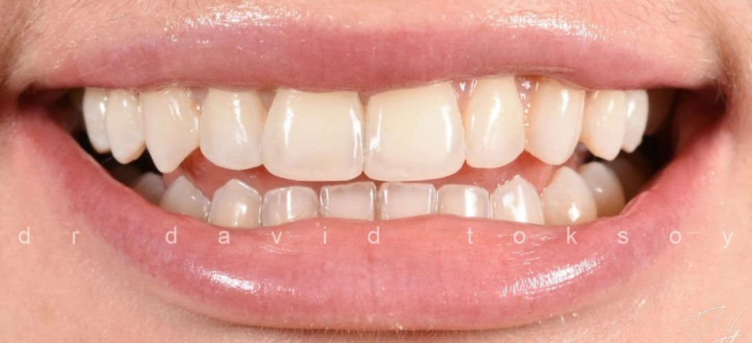 Case 4 After