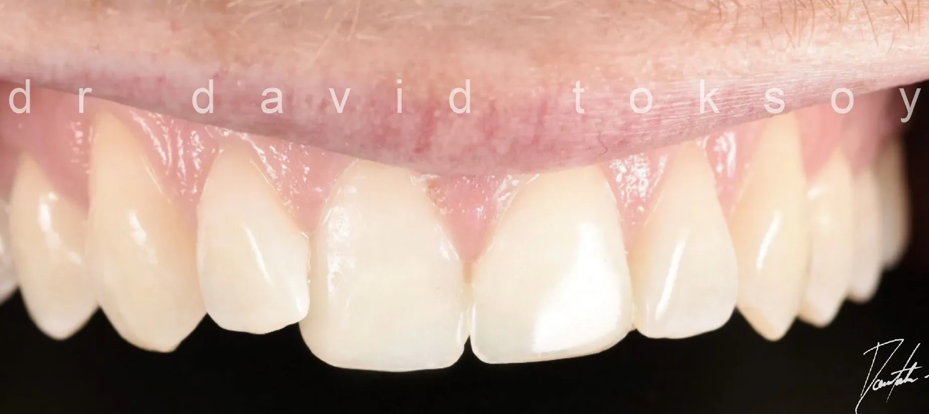 Case 5 After