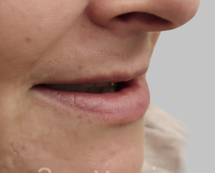 Dental Implant-iages (1)