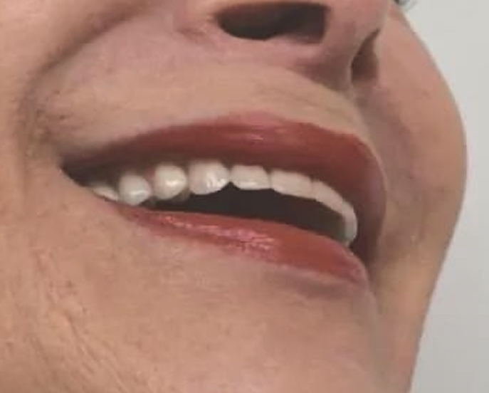 Dental Implant-iages (2)