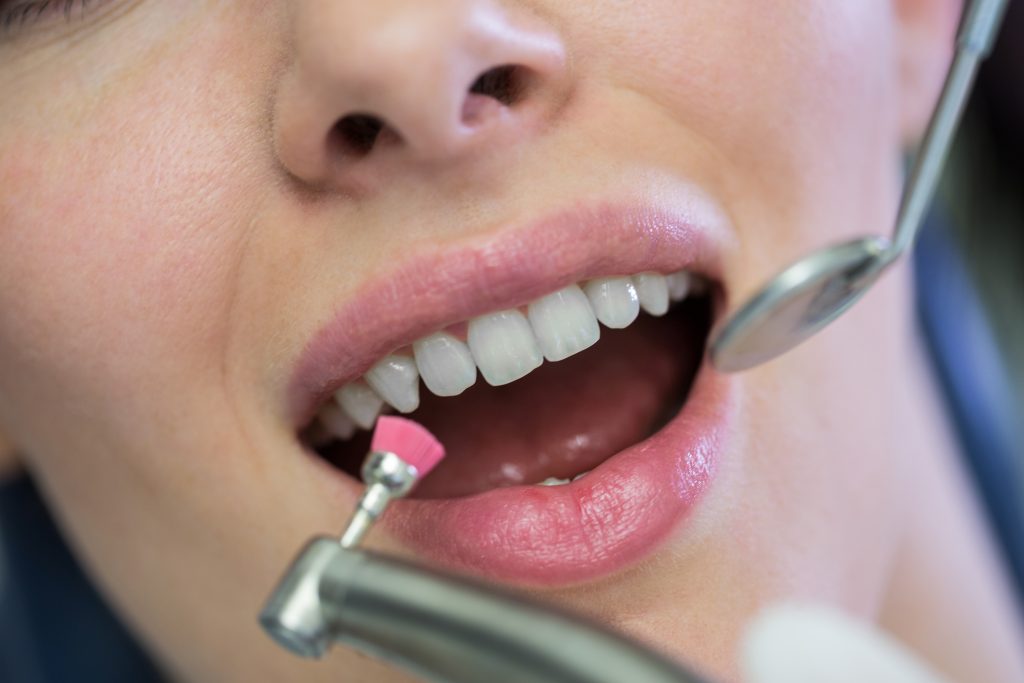 How Long Do Veneers Last? Replacement, Repairs, and Maintenance Banner