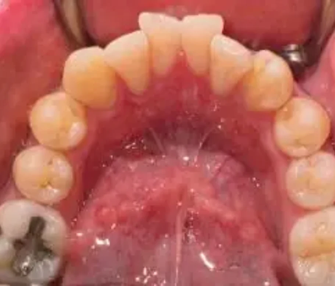 Invisalign-images (1)
