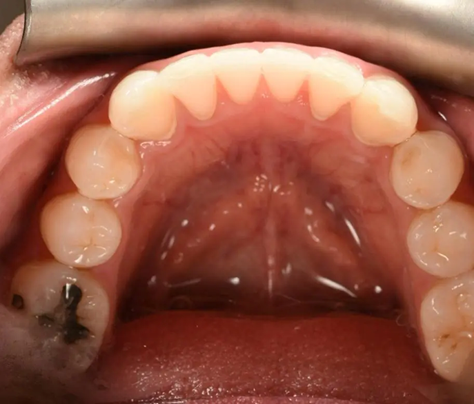 Invisalign-images (2)