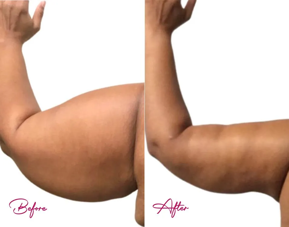 Arm Lift - Case 1