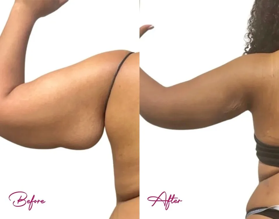 Arm Lift - Case 2