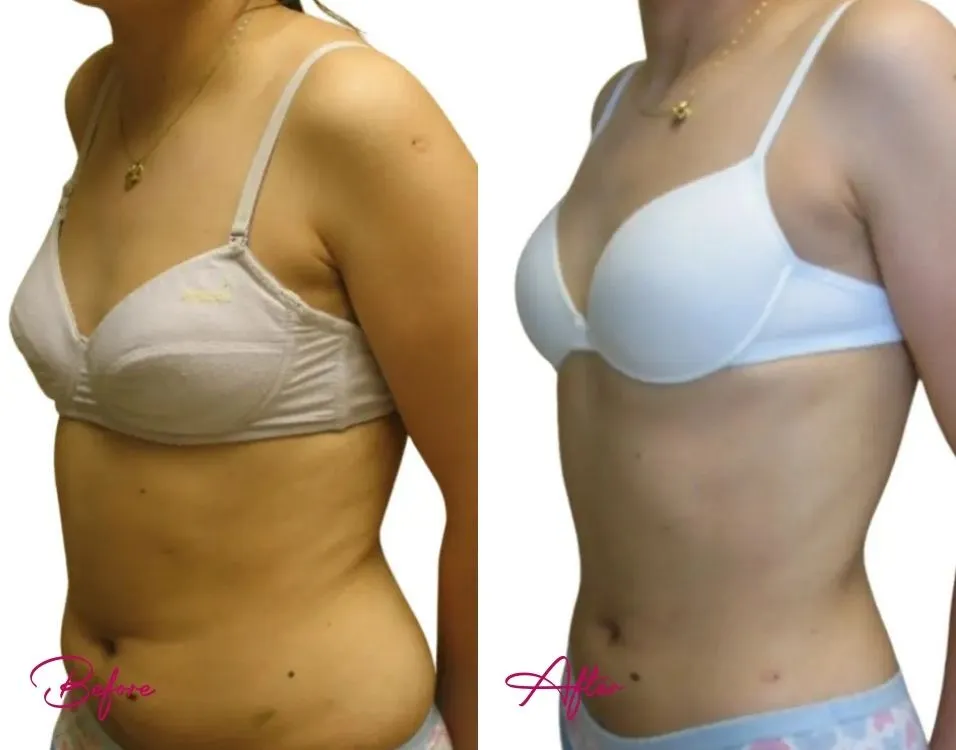 Awake Liposuction - Case 1