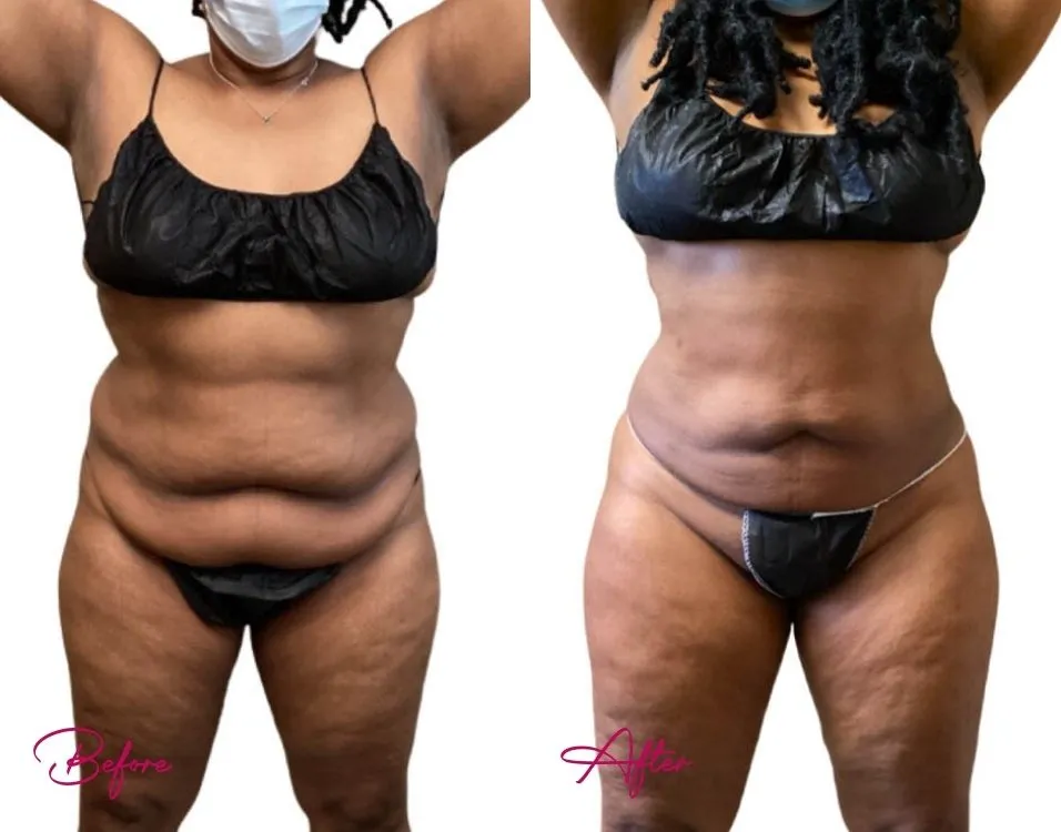 Awake Liposuction - Case 10