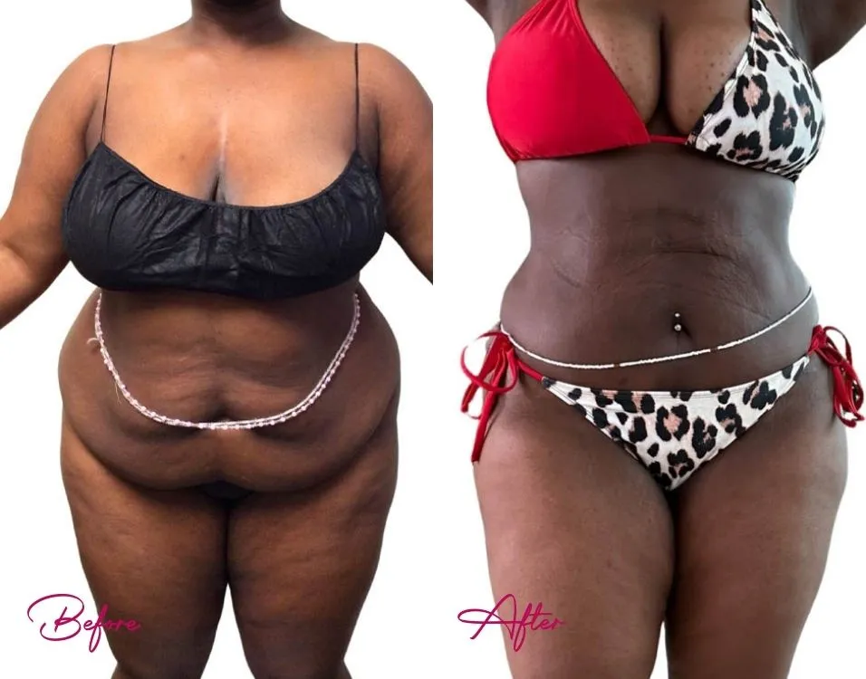 Awake Liposuction - Case 12