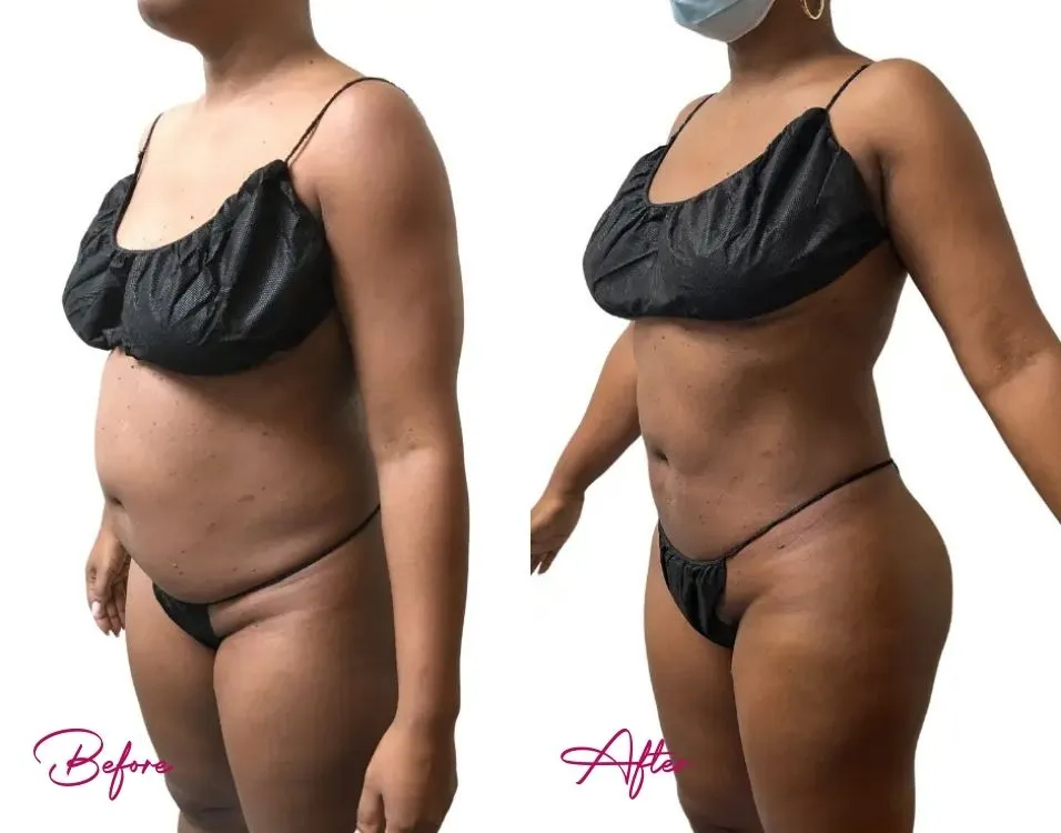 Awake Liposuction - Case 2