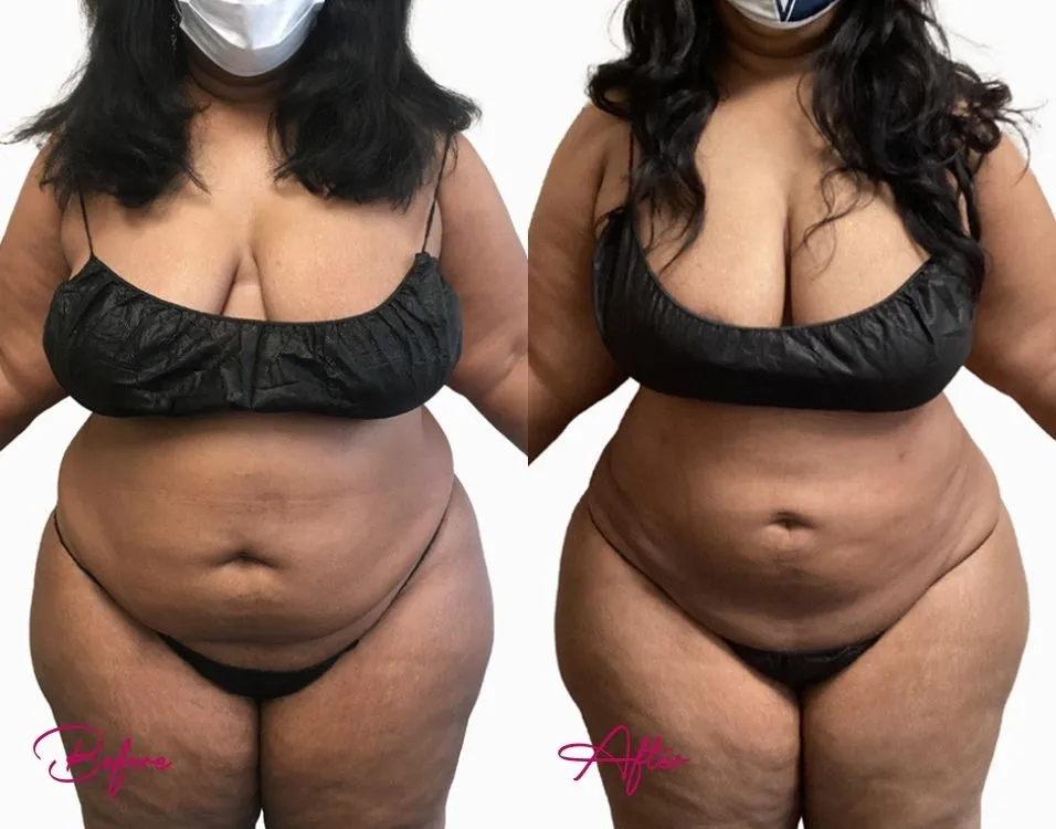 Awake Liposuction - Case 3