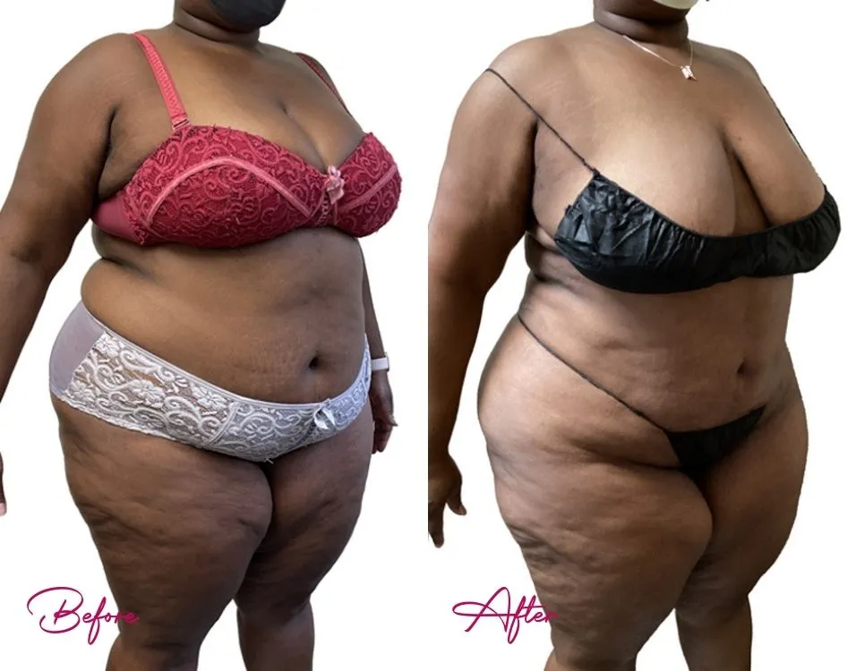 Awake Liposuction - Case 4.1