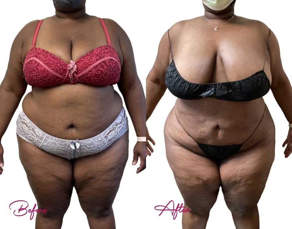 Awake Liposuction - Case 4