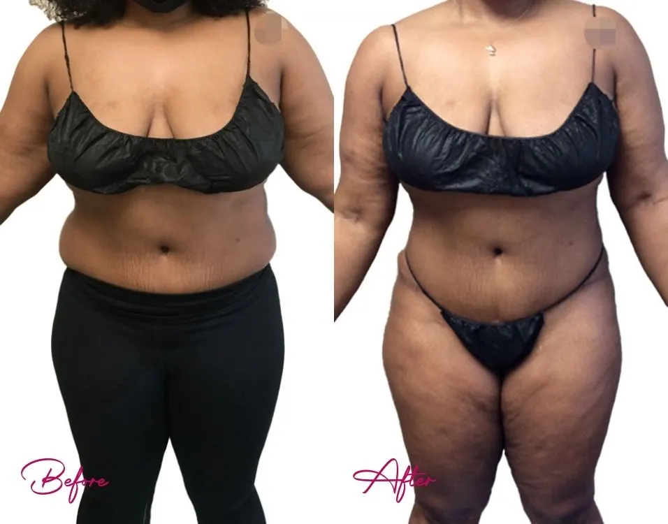 Awake Liposuction - Case 5.1