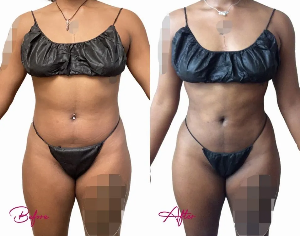 Awake Liposuction - Case 6