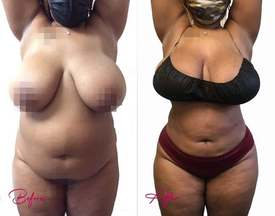 Awake Liposuction - Case 7
