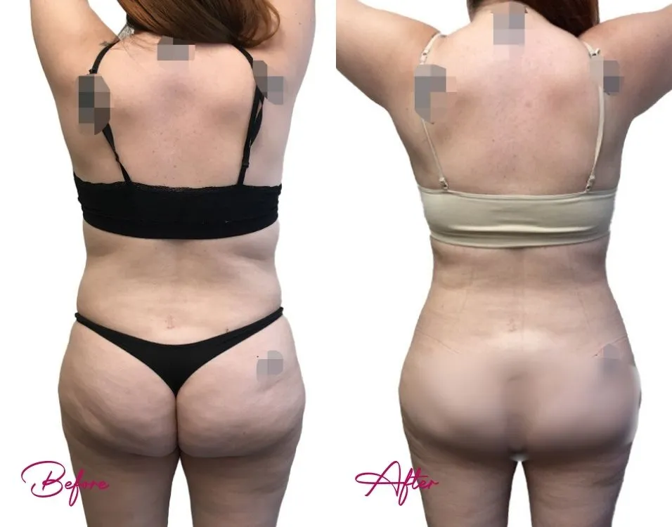 Awake Liposuction - Case 8