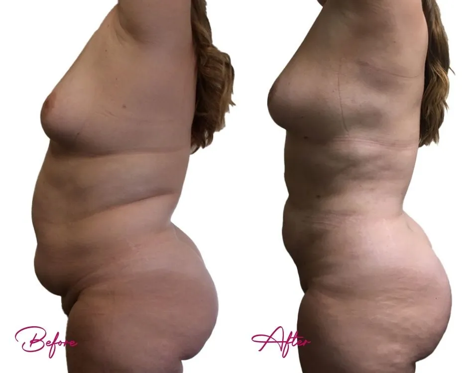 Awake Liposuction - Case 9