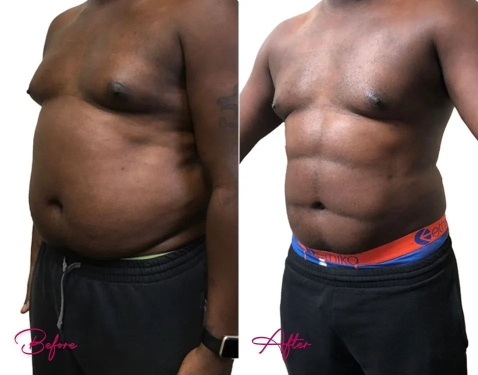 Awake Liposuction (MALE) - Case 1