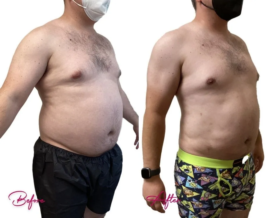 Awake Liposuction (MALE) - Case 2