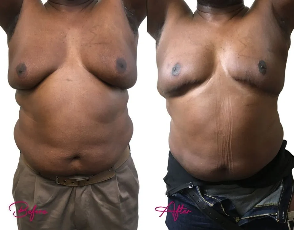 Awake Liposuction (MALE) - Case 3