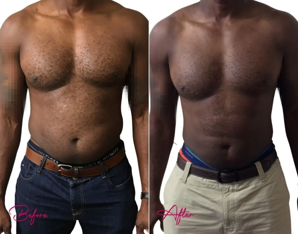 Awake Liposuction (MALE) - Case 4