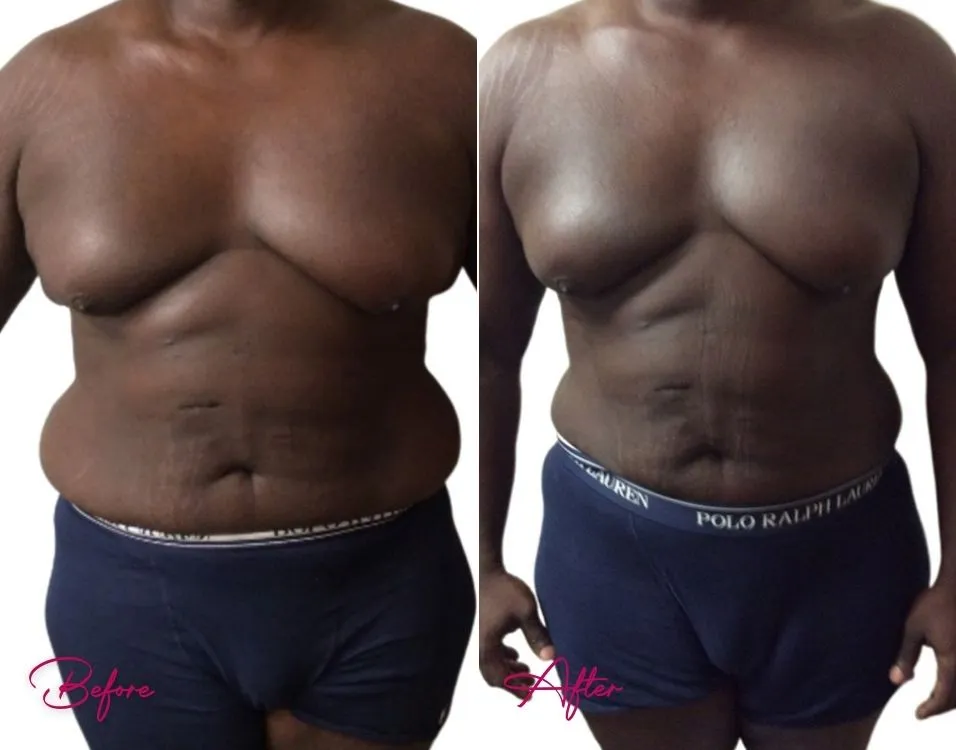 Awake Liposuction (MALE) - Case 5