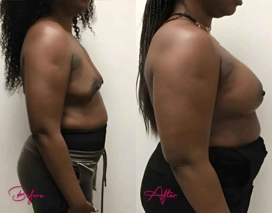 Breast Augmentation - Case 2