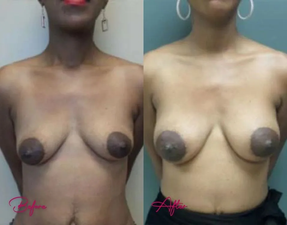 Breast Augmentation - Case 5