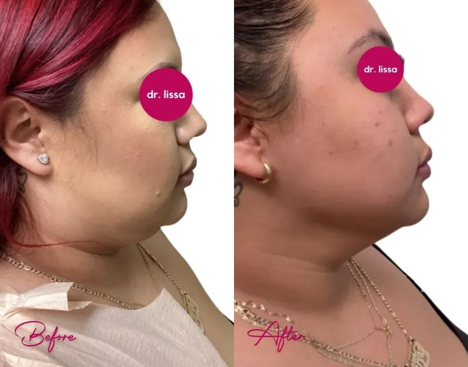 Chin and Neck Liposuction - Case 2