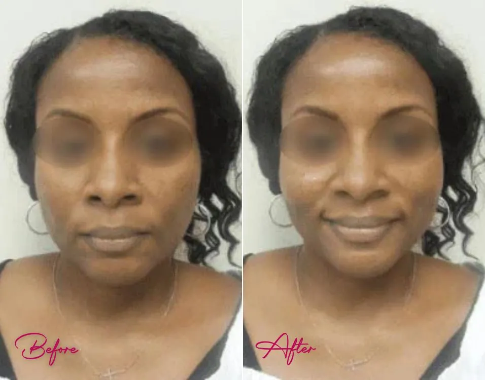 Juvederm - Case 1