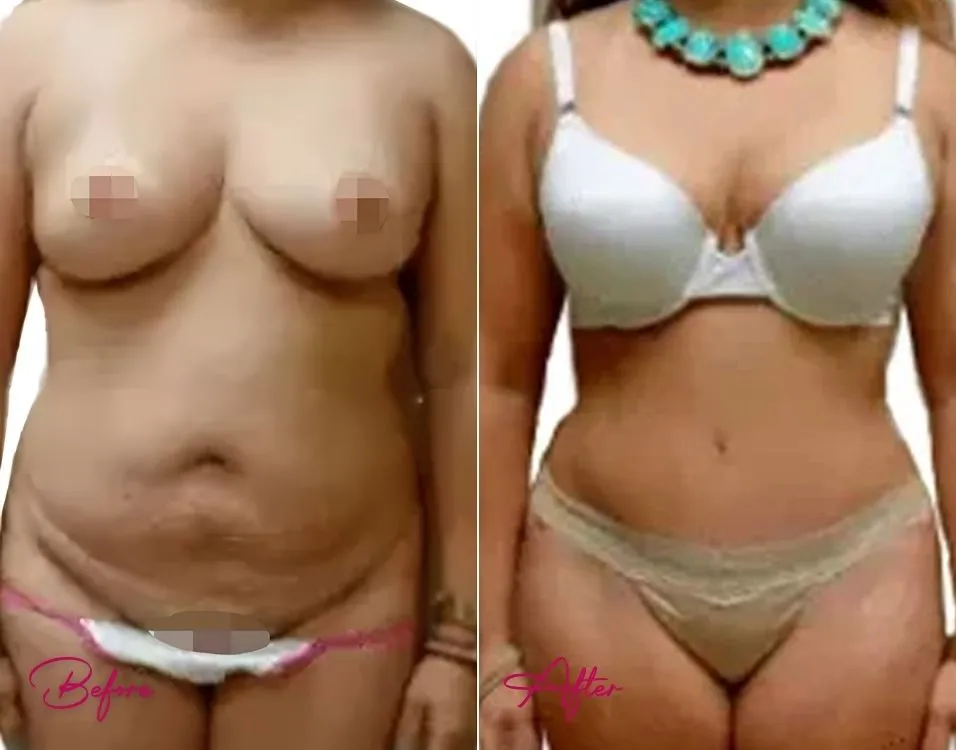 Tummy Tuck - Case 1