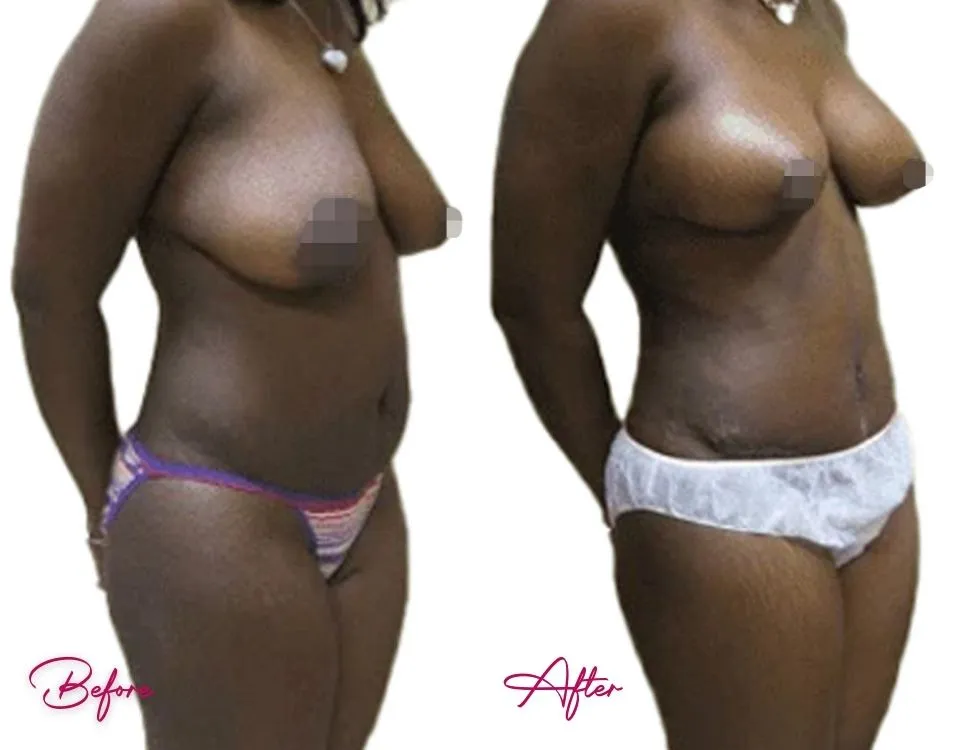 Tummy Tuck - Case 10