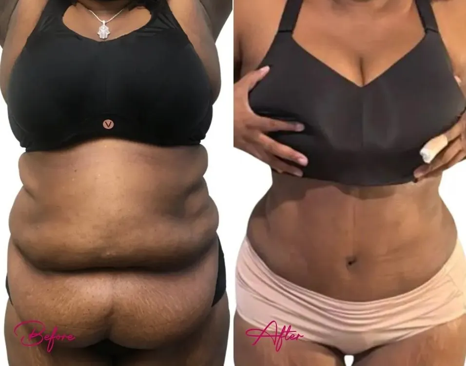 Tummy Tuck - Case 13