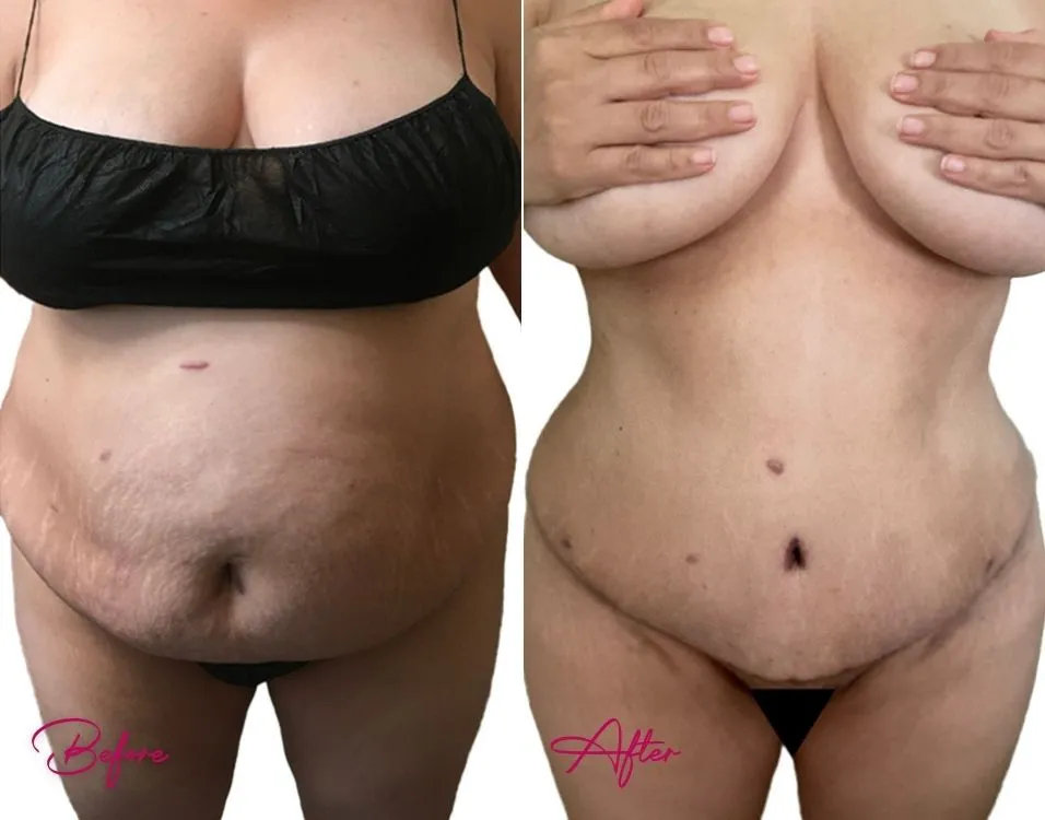Tummy Tuck - Case 17