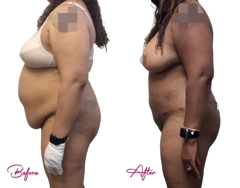 Tummy Tuck - Case 19