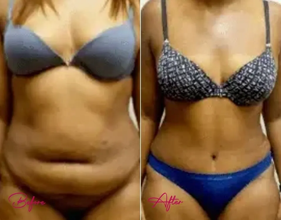 Tummy Tuck - Case 2