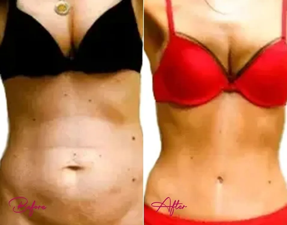 Tummy Tuck - Case 3