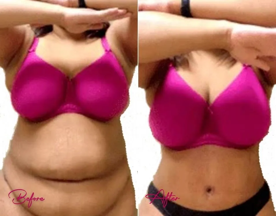 Tummy Tuck - Case 4