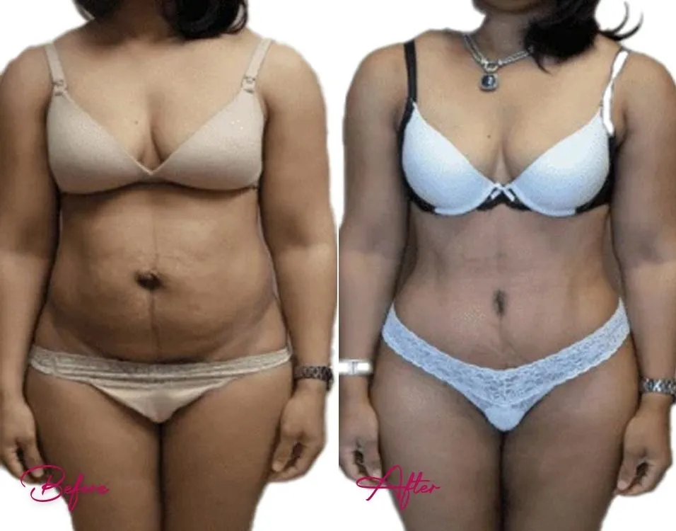 Tummy Tuck - Case 5.1