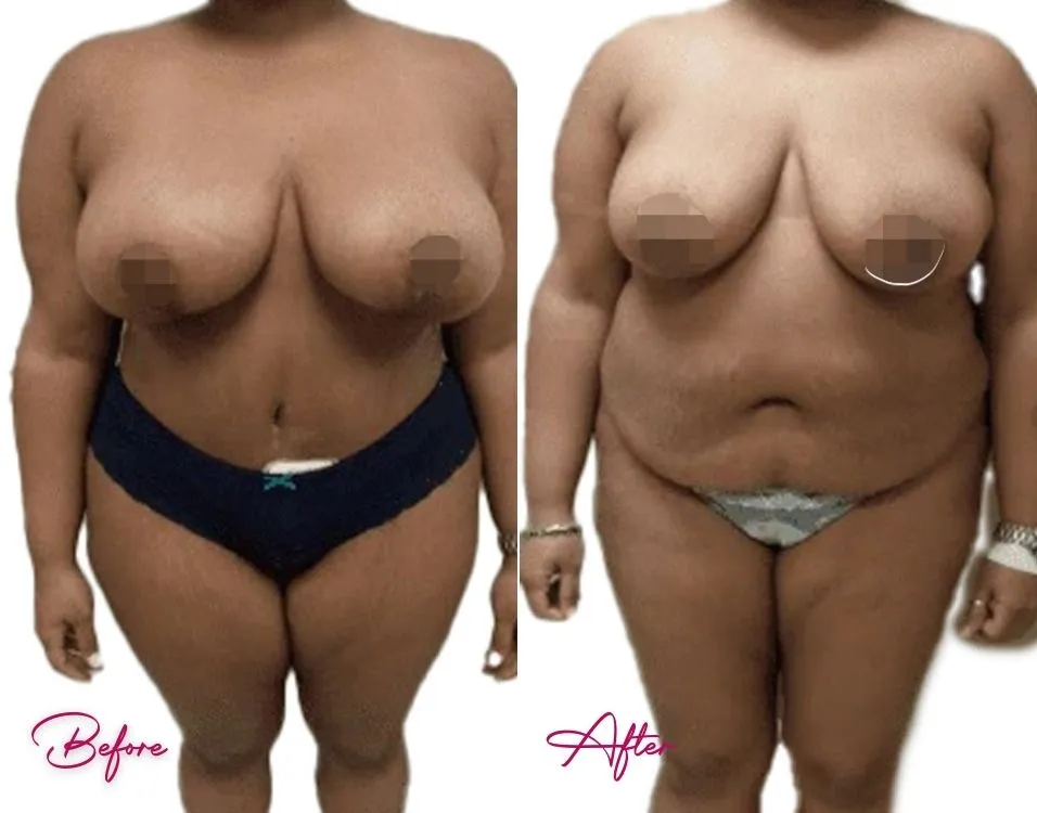 Tummy Tuck - Case 6