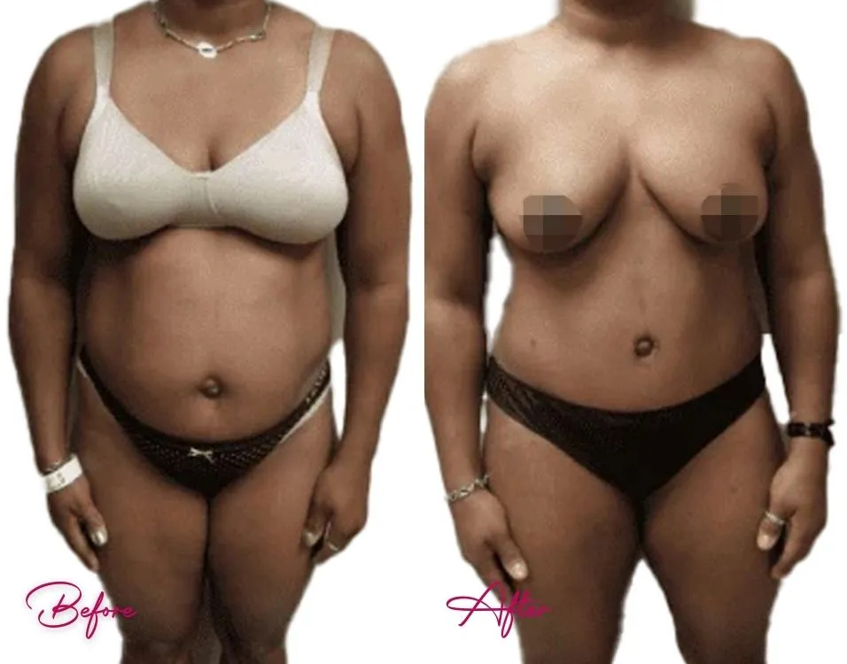 Tummy Tuck - Case 7