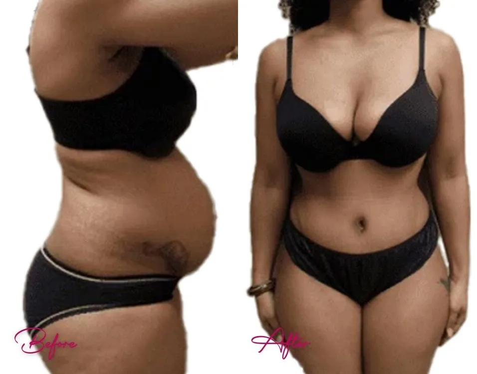 Tummy Tuck - Case 8